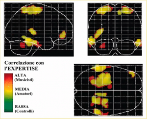Immagini del cervello con aree colorate in modo diverso a seconda dell'intensità di studio della musica